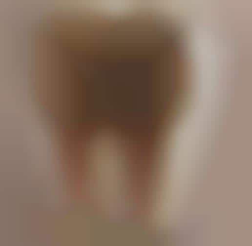 Rotting Tooth Campaigns