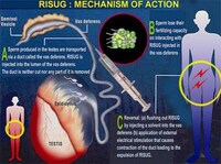 Reversible Male Birth Control