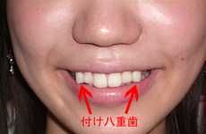 Reverse Orthodontia Procedures