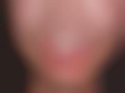 Reverse Orthodontia Procedures