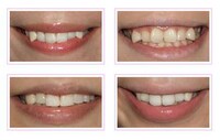 Reverse Orthodontia Procedures Image 2