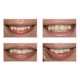 Reverse Orthodontia Procedures Image 2