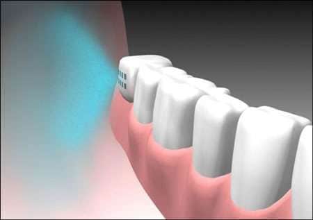 Take Your Medication Via Tooth Implant