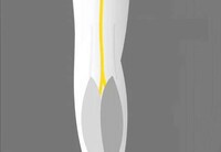 Portable Blood Pumpers Image 2
