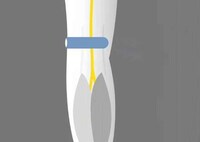 Portable Blood Pumpers Image 4