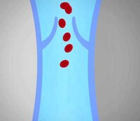 Portable Blood Pumpers Image 8
