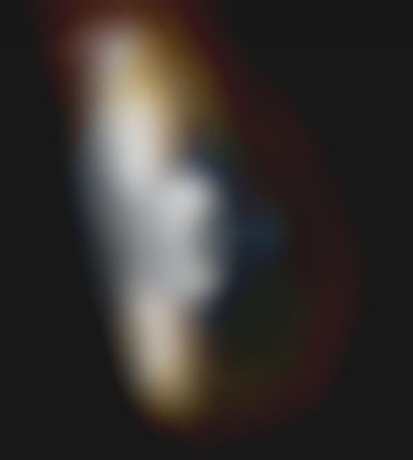 Corrective Ocular Implants (UPDATED)