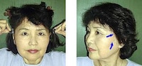 Skin-Stretching Clips Image 2