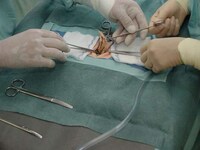 No-Incision Appendectomies Image 2