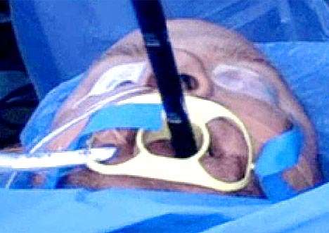 No-Incision Appendectomies 2