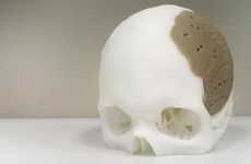 3D-Printed Skull Implants