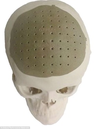 3D-Printed Skull Implants Image 2