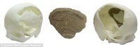 3D-Printed Skull Implants Image 4