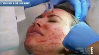 Blood-Recycling Beauty Facials Image 2