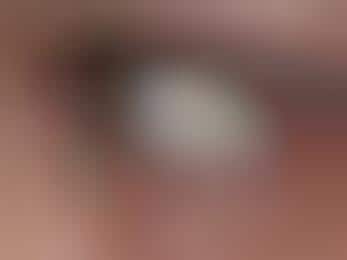 Surgically Implanted Eye Jewelry (UPDATE)