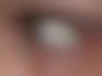 Surgically Implanted Eye Jewelry (UPDATE)