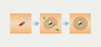 Windowed Band-Aids Image 3