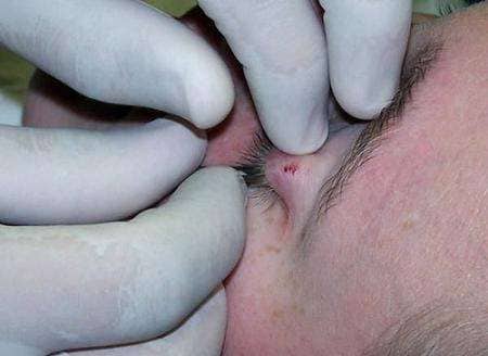 Eyelid Piercing