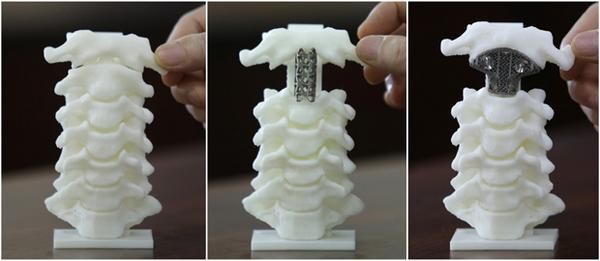 3D-Printed Spinal Surgeries