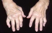 Arthritic Innovations Image 3