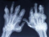 Arthritic Innovations Image 4
