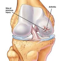 Arthritic Innovations Image 5