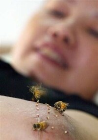 Bee Venom Therapy Image 3