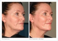 Non-Invasive Face Lifts Image 2