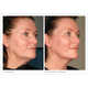 Non-Invasive Face Lifts Image 2