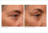 Non-Invasive Face Lifts Image 3