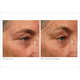 Non-Invasive Face Lifts Image 3