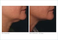 Non-Invasive Face Lifts Image 4