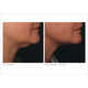 Non-Invasive Face Lifts Image 4