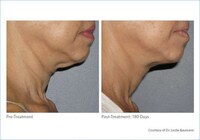 Non-Invasive Face Lifts Image 5
