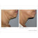 Non-Invasive Face Lifts Image 5