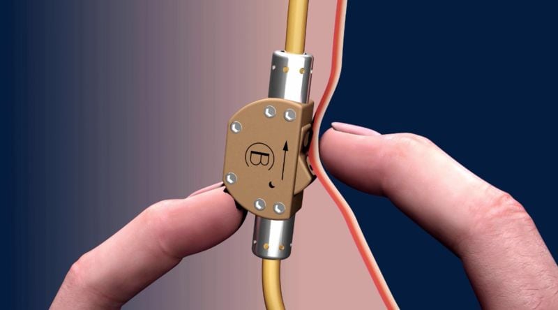 Male Contraception Gadgets : male birth control
