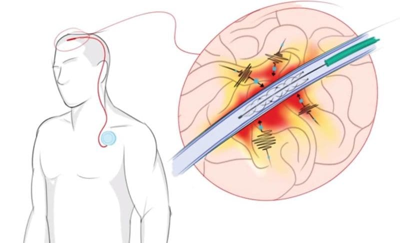 Limb-Controlling Implants