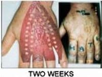 Hardcore Tattoo Removal Image 2