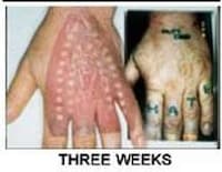 Hardcore Tattoo Removal Image 3