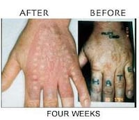 Hardcore Tattoo Removal Image 4