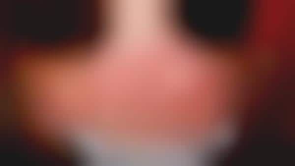 Color-Changing Sunburn Sensors