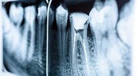 Regenerative Tooth Fillings Image 2