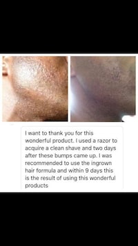 All-Natural Ingrown Hair Aids Image 7