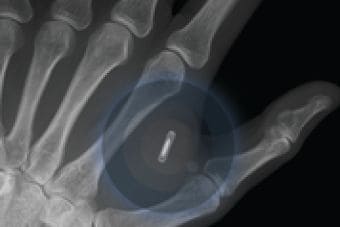 Tech-Controlling Implantable Microchips