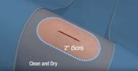 Non-Invasive Bandage Stitches Image 2