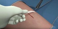 Non-Invasive Bandage Stitches Image 4
