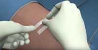Non-Invasive Bandage Stitches Image 5