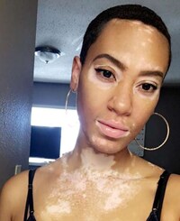 Vitiligo Model-Inclusive Beauty Campaigns Image 2