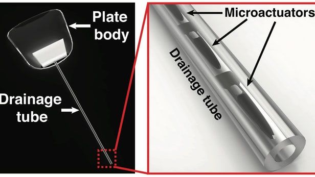 Magnetic Glaucoma Implants