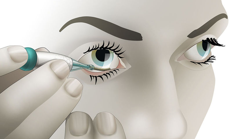 Glucose-Monitoring Contact Lenses